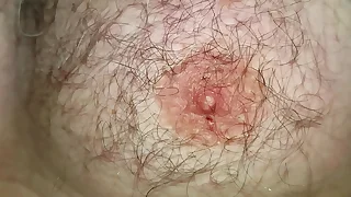 Foley catheter and safety-pins extraction